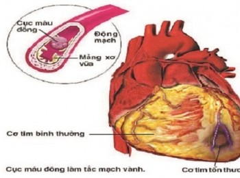 Nhồi máu cơ tim diễn ra như thế nào? Sinh lý bệnh nhồi máu cơ tim