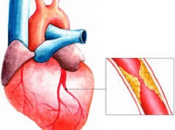 Thiếu máu cơ tim có chữa được không?