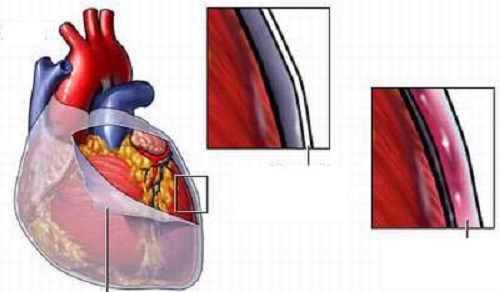 Viêm màng ngoài tim cấp - Các biến chứng nguy hiểm nhồi máu cơ tim
