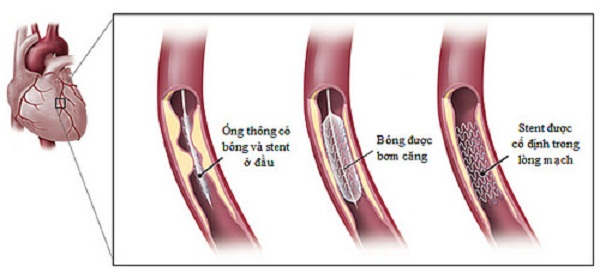 đặt stent mạch vành