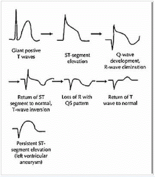 Các giai đoạn trên điện tâm đồ nhồi máu cơ tim
