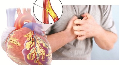 Bệnh mạch vành do các mảng xơ vữa gây ra
