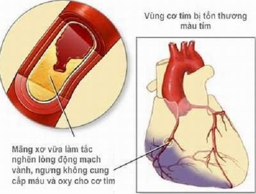 Bệnh mạch vành gây thiếu máu cục bộ cơ tim
