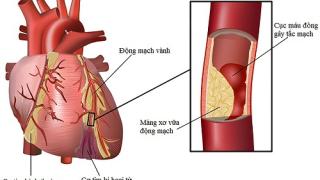 Bệnh động mạch vành nên ăn gì để có sức khỏe tốt nhất?