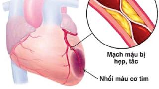 Bệnh hẹp mạch vành và những điều nên biết