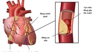 Biến chứng của xơ vữa động mạch