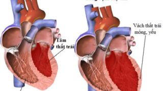 Bố mẹ bạn có đang mắc suy tim?