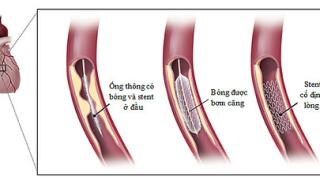 Cách hỗ trợ chữa hẹp tắc động mạch vành hiệu quả