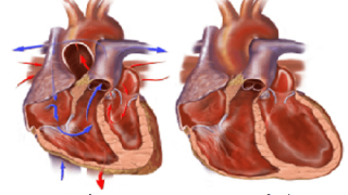Cập nhật về phân độ suy tim hiện nay
