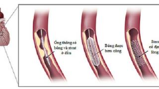 Lời khuyên sau đặt stent mạch vành
