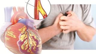 Cơ chế gây nên bệnh mạch vành