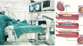 Đặt Stent mạch vành: Chi phí và tác dụng không mong muốn