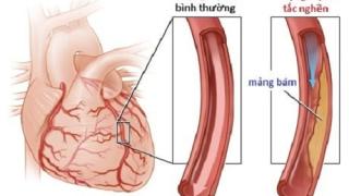 Các phương pháp điều trị bệnh mạch vành