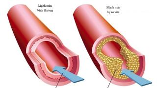 Giải pháp cho người mắc bệnh tim mạch nhất thiết phải biết