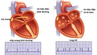 Nhịp tim bình thường của trẻ em là bao nhiêu? Lưu ý khi nhịp tim không bình thường