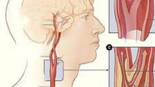 Canh cánh nỗi lo bị liệt nửa người vì xơ vữa động mạch cảnh