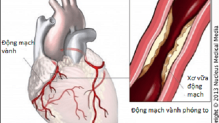 Phòng bệnh mạch vành hiệu quả