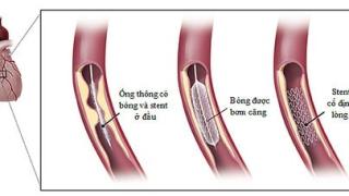 Bệnh mạch vành vẫn chưa "xong" sau đặt stent