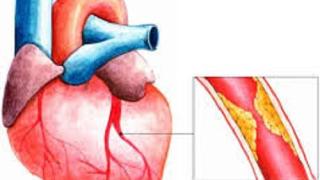 Thiếu máu cơ tim có chữa được không?