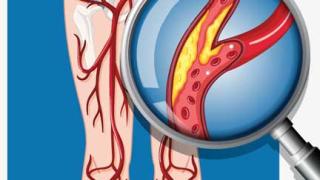 Bệnh động mạch ngoại vi mãn tính