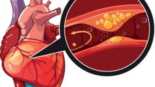 Những biện pháp giúp ngăn chặn nguy cơ gây bệnh động mạch vành