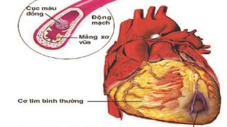 Người bệnh tim mạch ai nên dùng và không nên dùng aspirin?