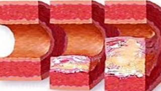 Những nguyên nhân gây Xơ vữa động mạch theo Y học hiện đại