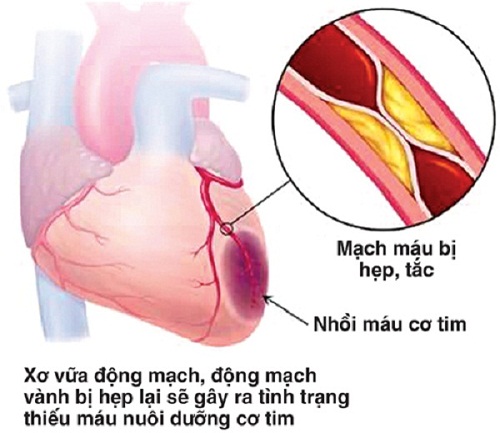 Bệnh hẹp mạch vành và những điều nên biết