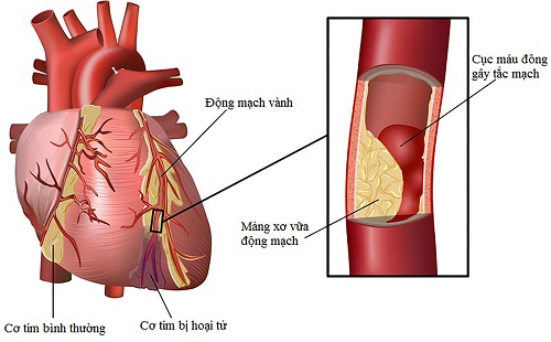 Bệnh mạch vành có chữa khỏi không?