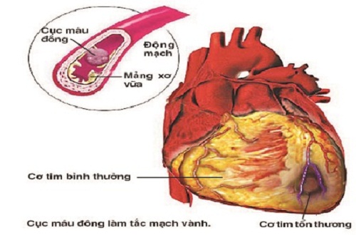 Thiếu máu cơ tim có thể dẫn một số biến chứng nguy hiểm