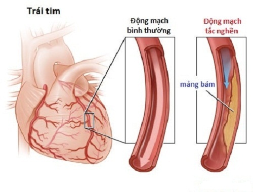 Bệnh động mạch vành là bệnh tim mạch hay gặp ở người lớn tuổi