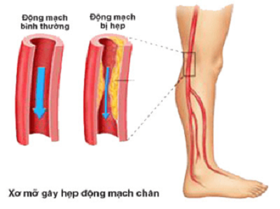 Biến chứng của xơ vữa động mạch 2