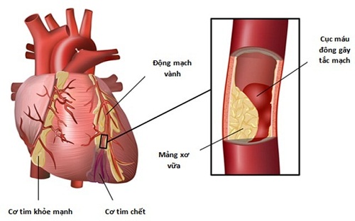 Biến chứng của xơ vữa động mạch