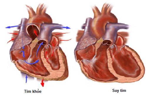 Suy tim là biến chứng nguy hiểm của nhồi máu cơ tim