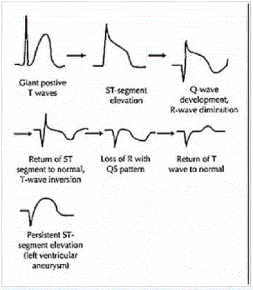 Tầm quan trọng và hình ảnh của điện tâm đồ nhồi máu cơ tim