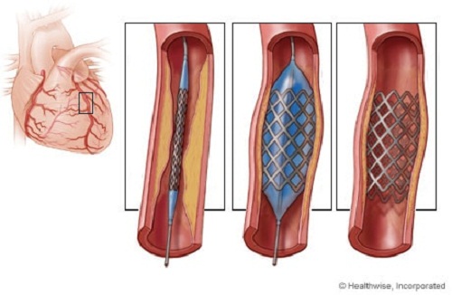 Đặt stent là phương pháp điều trị bệnh mạch vành hay được sử dụng