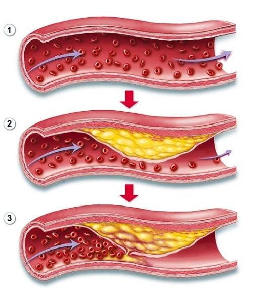 Nguyên nhân dẫn đến nhồi máu cơ tim
