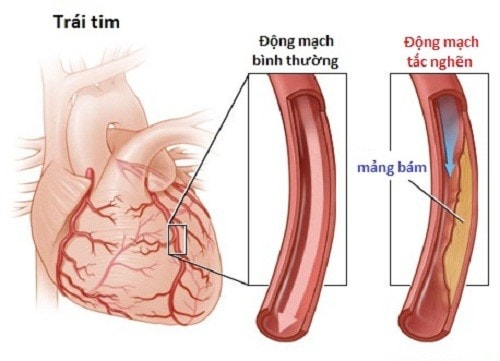 Bệnh suy tim trái- Nguyên nhân và triệu chứng