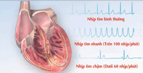 Những nguyên nhân gây suy tim cần phải cảnh giác 2