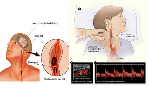 Siêu âm động mạch cảnh giúp chẩn đoán xơ vữa động mạch cảnh