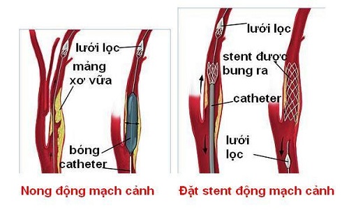 Phương pháp nong và đặt stent động mạch cảnh