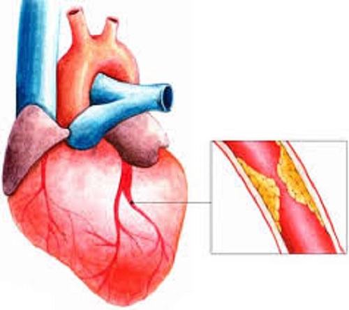 Thiếu máu cơ tim có chữa được không?