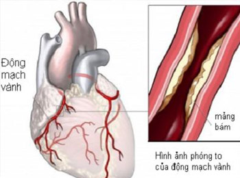 Phát hiện sớm và phòng ngừa bệnh mạch vành