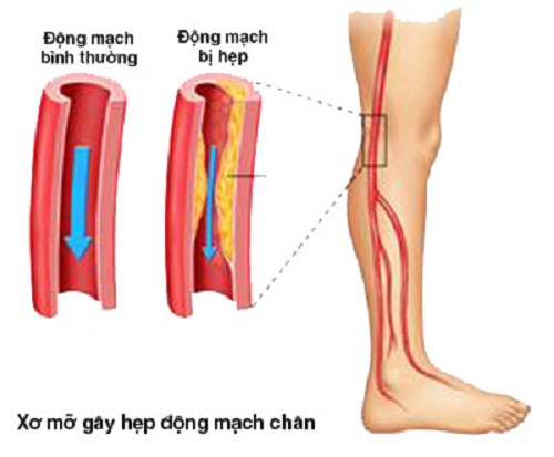 Bệnh xơ vữa động mạch chi dưới là gì?